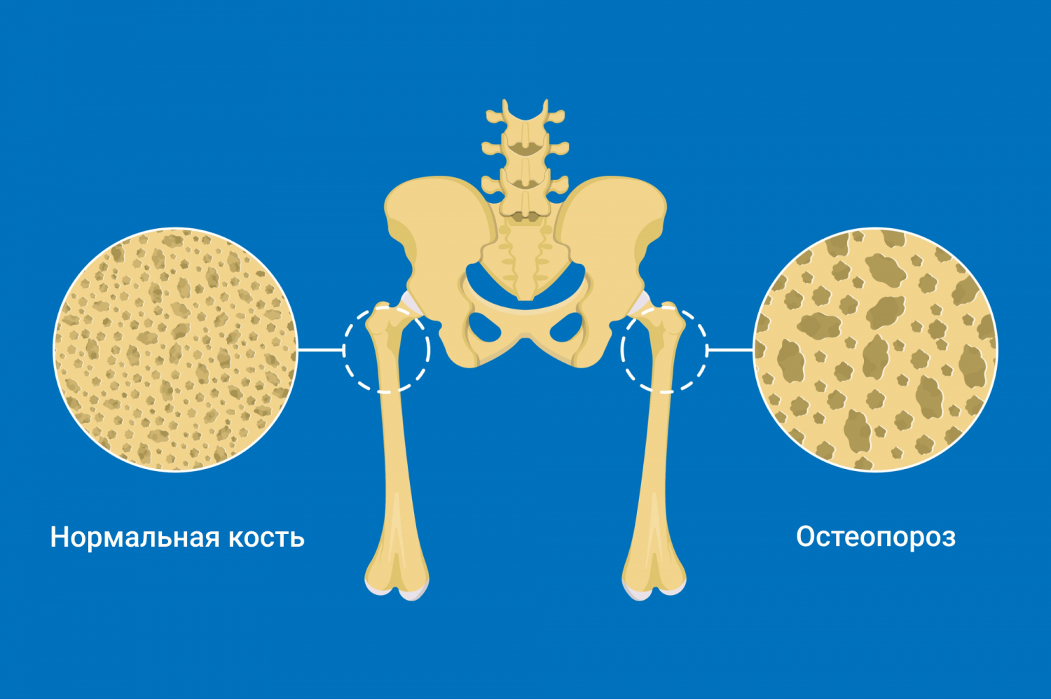 Самые хрупкие кости